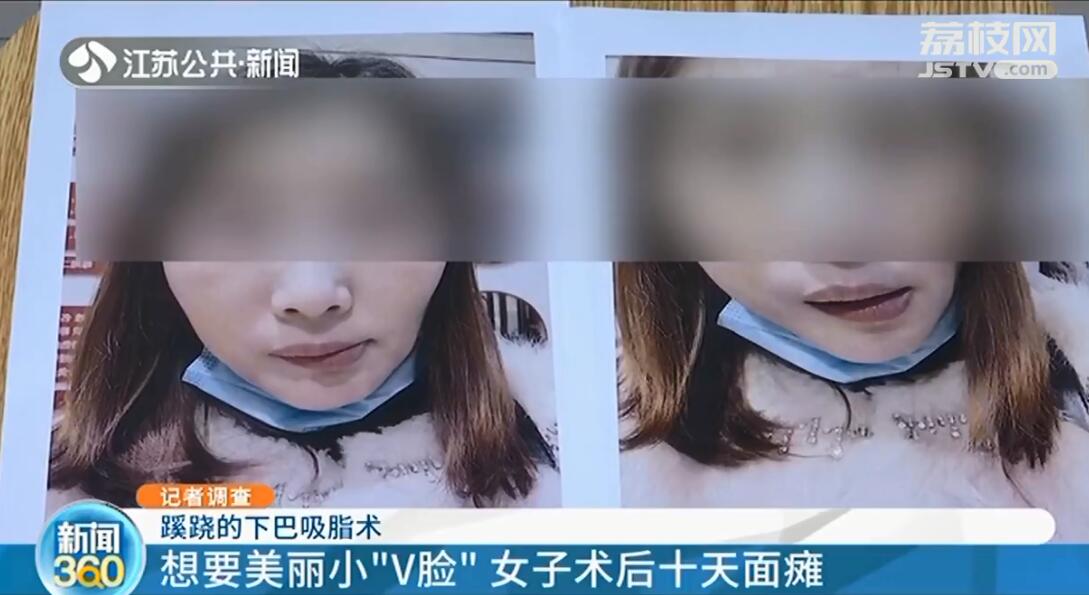 院长手术后续完整版,院长吸脂手术