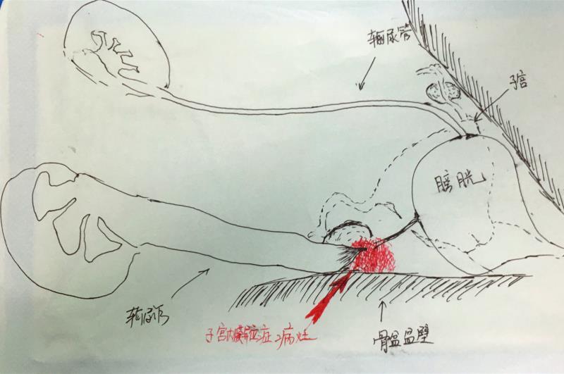 长沙40岁女士腰疼半年右肾重度积水，原来是妇科病作怪