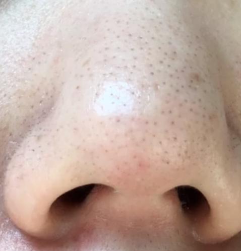 去除又黑又硬的黑头的方法,怎么祛除黑头的最有效方法