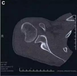 所有骨折都叫什么名字,骨折的名称有哪些