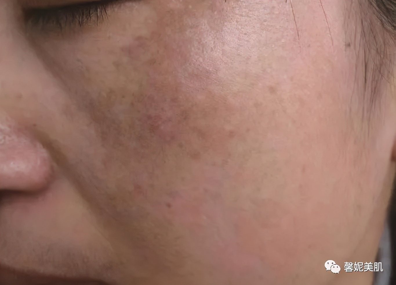 褐青色痣和太田痣区别,褐青色痣是太田痣吗