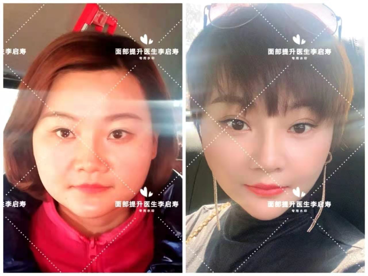 小切口拉皮和筋膜折叠哪种效果好,筋膜提升和剥离大拉皮的区别