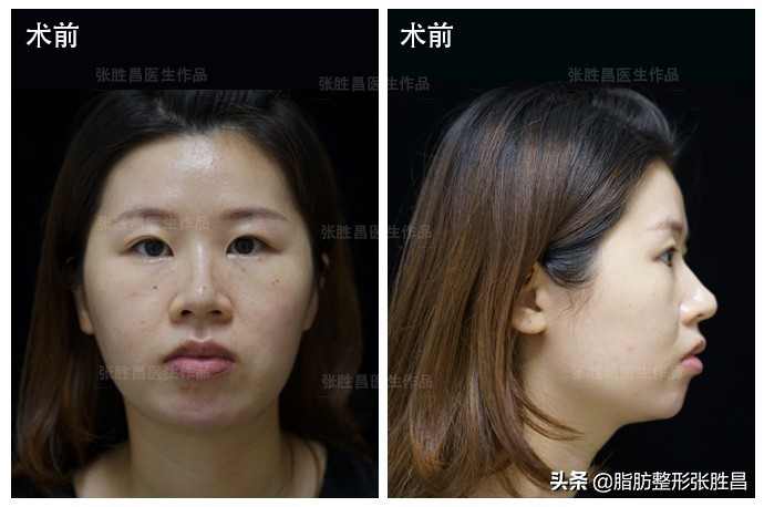 后缩的下巴打玻尿酸效果会好吗,下巴后缩打玻尿酸有效果吗