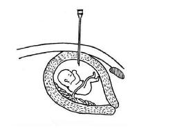 胎儿染色体检查结果为低风险,胎儿染色体检查准确性高吗