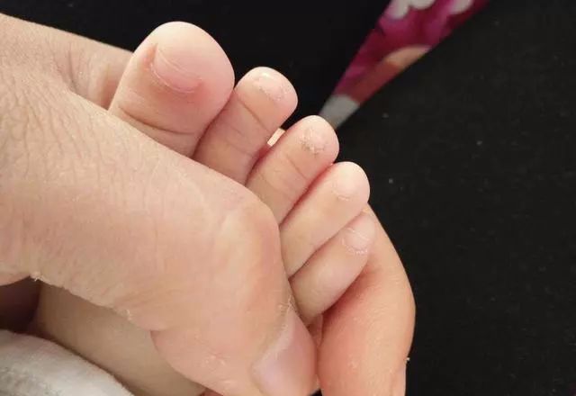 春季脸干燥起皮怎么缓解,脚部一年四季干燥起皮怎么办