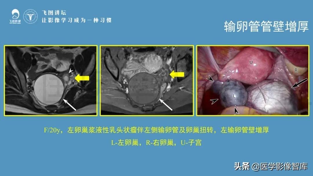 子宫解剖结构输卵管和卵巢位置,子宫附件ct影像学正常解剖表现