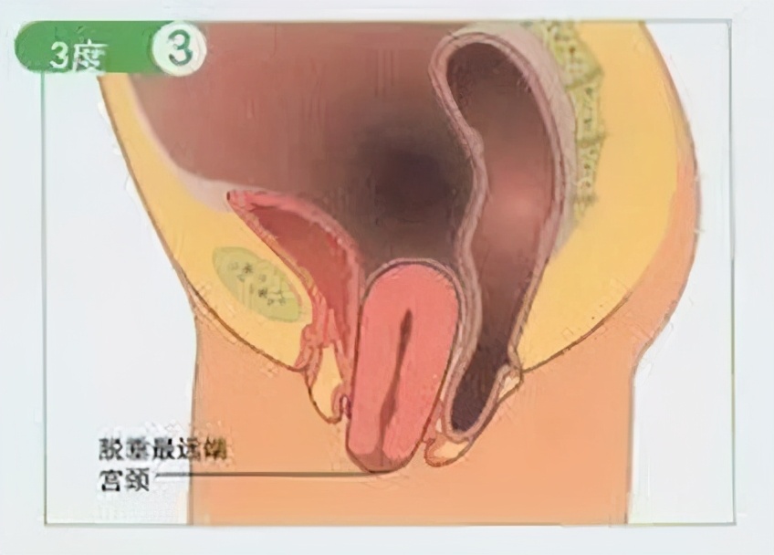 产后子宫轻度脱垂的人多吗,产后子宫脱垂和阴道壁膨出症状