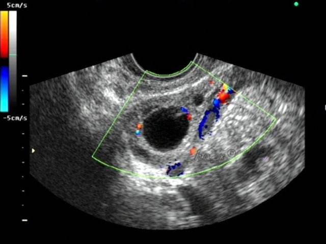 什么样的卵泡算优势卵泡,吃什么对卵泡质量好卵泡长得多呢