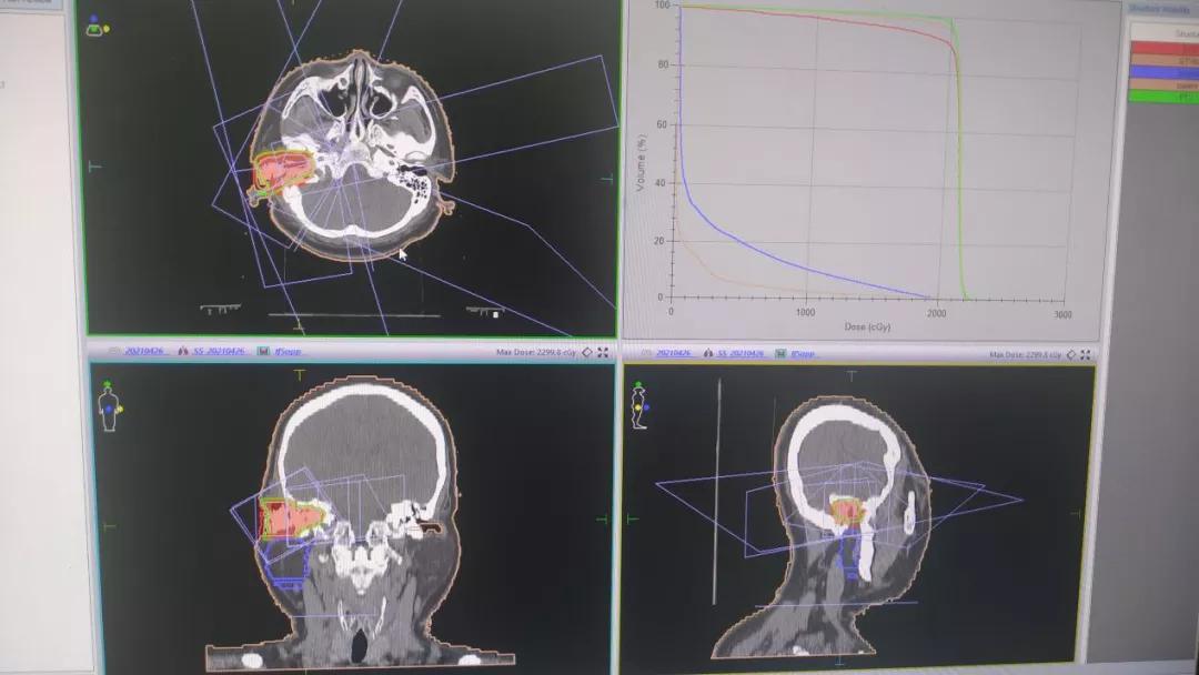 肿瘤放射治疗技术袖珍指南,肿瘤放射治疗技术改版