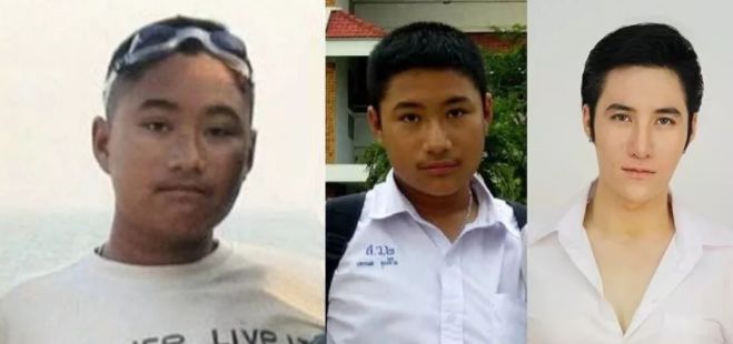 泰国抽脂腹肌,国外腹部抽脂真人演示