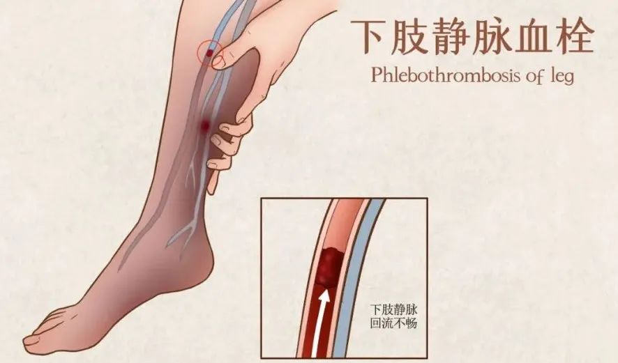 老年人骨折是保守治疗还是动手术,老年人腰骨折保守治疗有并发症状