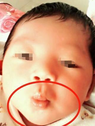 2岁儿子总撅“金鱼嘴”，妈妈还夸可爱，奶奶却抱起宝宝直奔医院