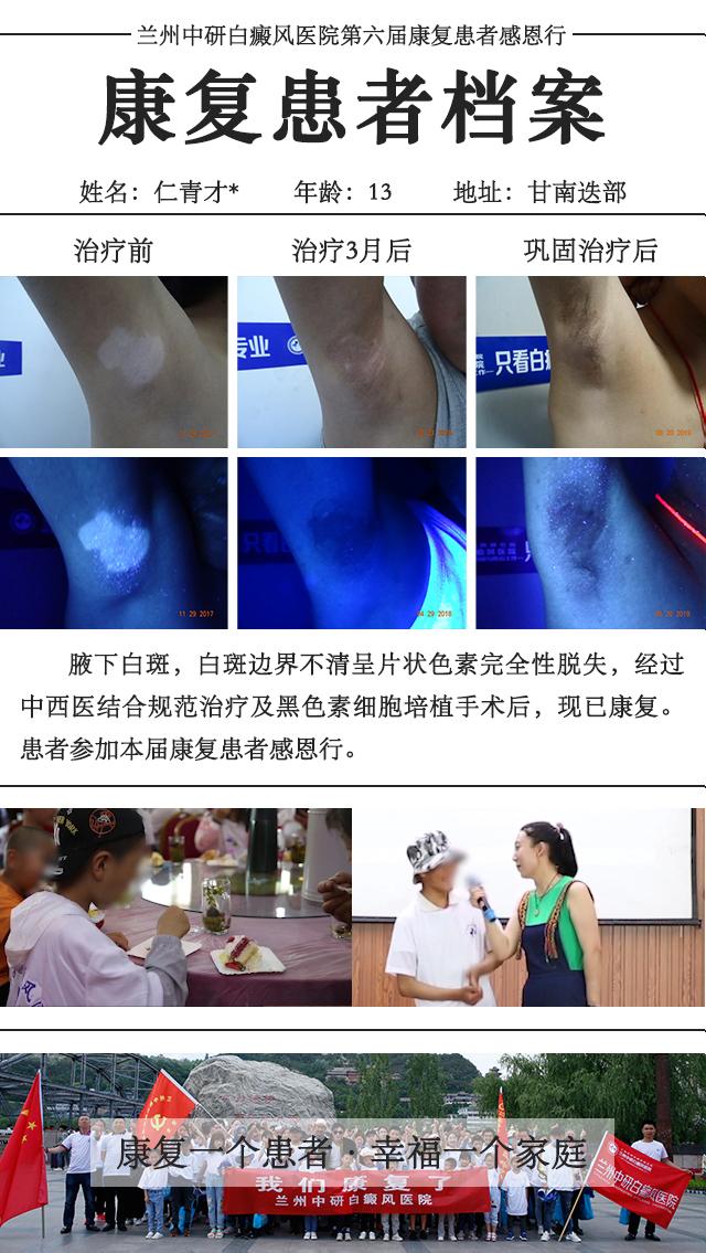 夏季美白祛痘印,夏季祛痘美白小窍门