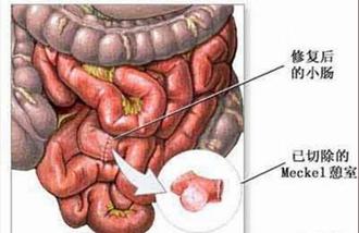 小儿梅克尔憩室炎不便血,蛋白质过敏宝宝便血