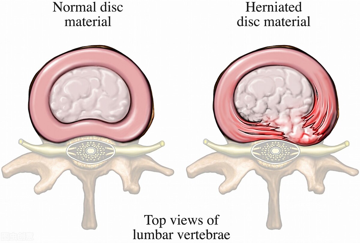 腰椎间盘突出打臭氧针属于微创吗,腰椎间盘突出臭氧还是射频效果好