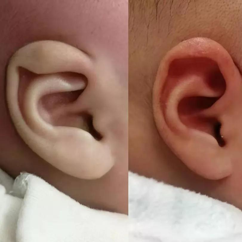 新生儿耳廓畸形需要抹什么药定型,新生儿耳朵轮廓畸形家长怎么办
