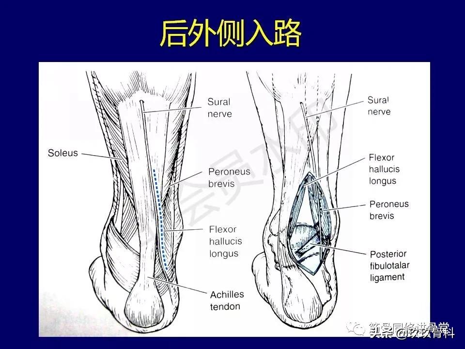 距骨骨折的治疗原则,距骨骨折如何调理