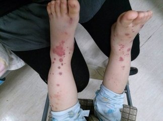 中西医结合治过敏性紫癜最好专家,中西医结合儿科过敏性紫癜