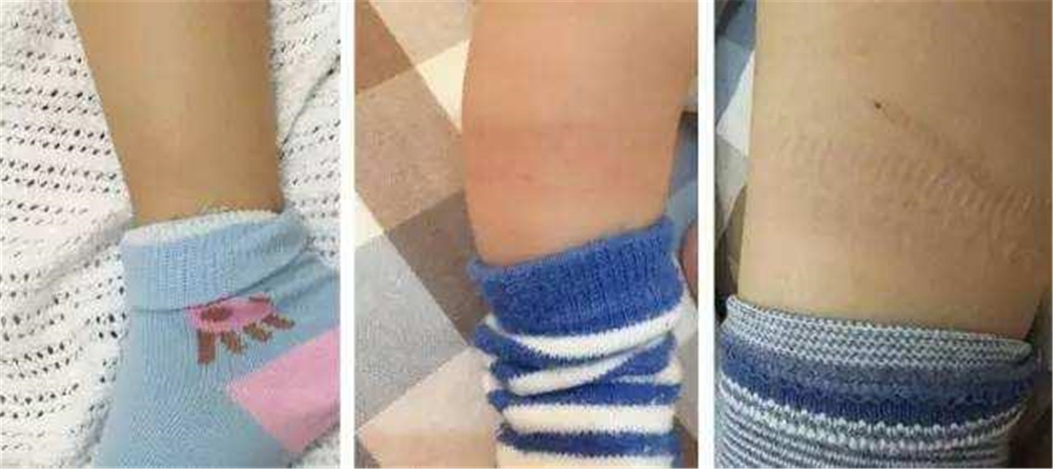 小孩怎么脱袜子脱鞋,小朋友爱脱袜子怎么把脚扎破的