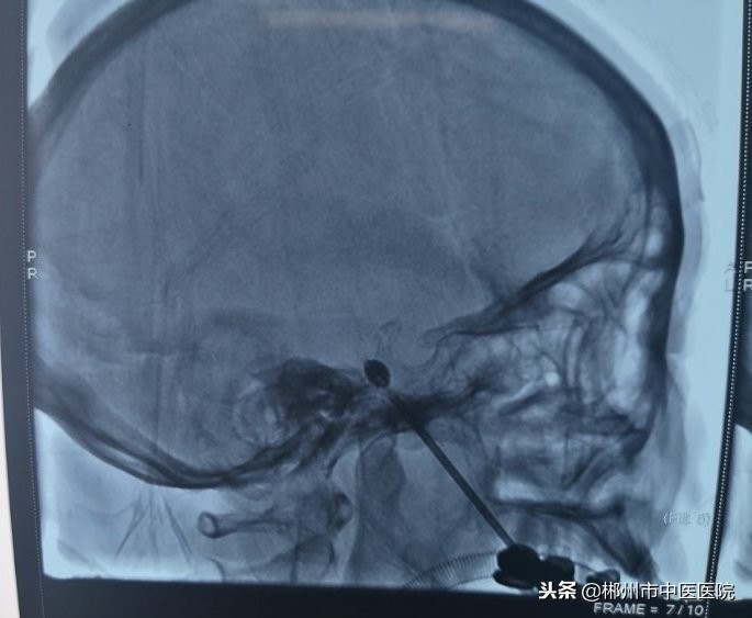 70多岁奶奶痛得连死的心都有，博士一针解决2万小时的痛不欲生