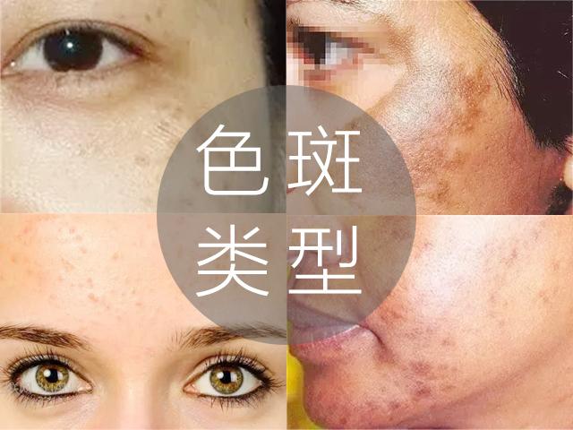 常见的色斑种类图文,脸部常见斑种类及图片