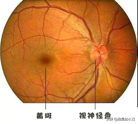 头疼眼疼视力模糊需要做ct,眼底黄斑病变会引起头疼吗