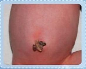 婴儿肚脐化脓新闻,出生小孩肚脐感染怎么办