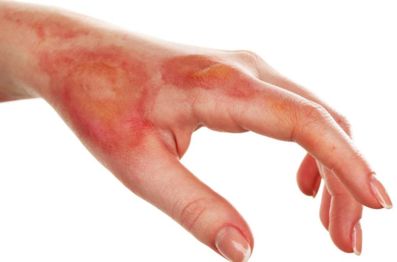 啤酒造成痛风的原因,啤酒为什么会导致痛风