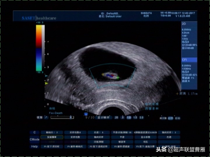 内见卵黄囊,卵黄囊肿瘤