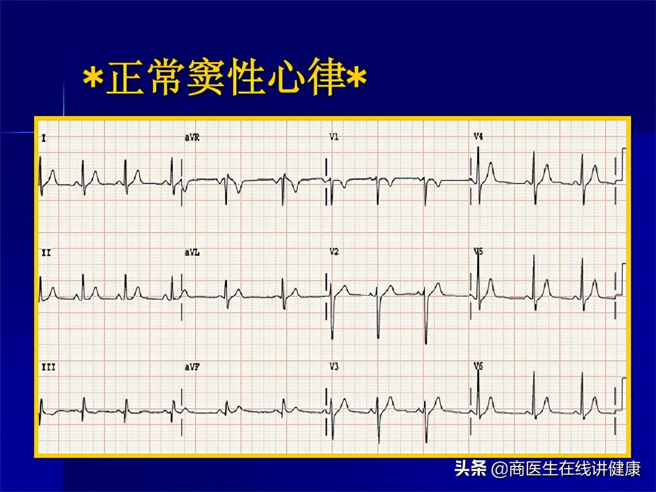 心跳越慢越长寿减少剧烈运动,心跳越慢人会更长寿