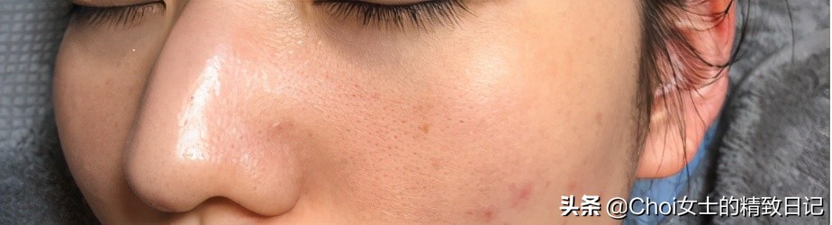 油皮痘痘护肤步骤的先后顺序,油皮痘肌护肤的正确步骤