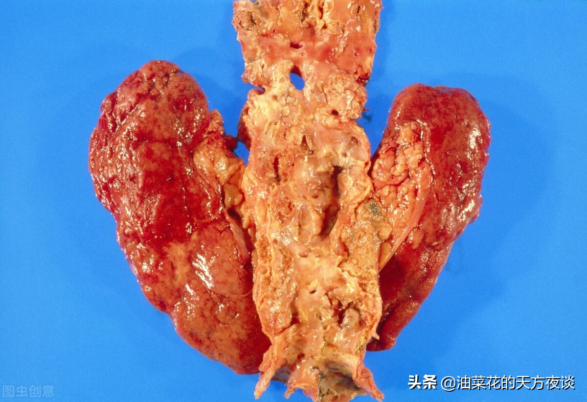 肾脏畸形,肾畸形有哪些类型