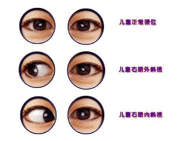 儿童斜视的原因及解决办法,关于小孩斜视