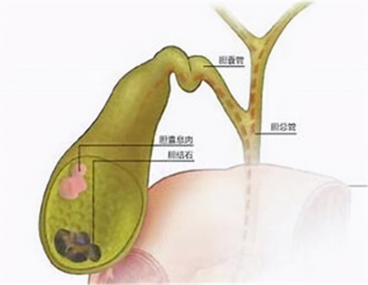 胆囊炎吃鸡蛋会是什么症状,胆囊炎胆结石能吃鸡蛋吗