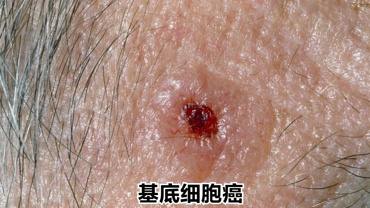 远离皮肤癌，只需要做到这三点，皮肤就会越来越健康