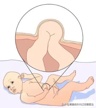 脐疝是什么意思呀,科普脐疝