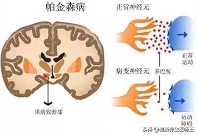 人体健康之运动神经元病,运动神经元病的锻炼方法