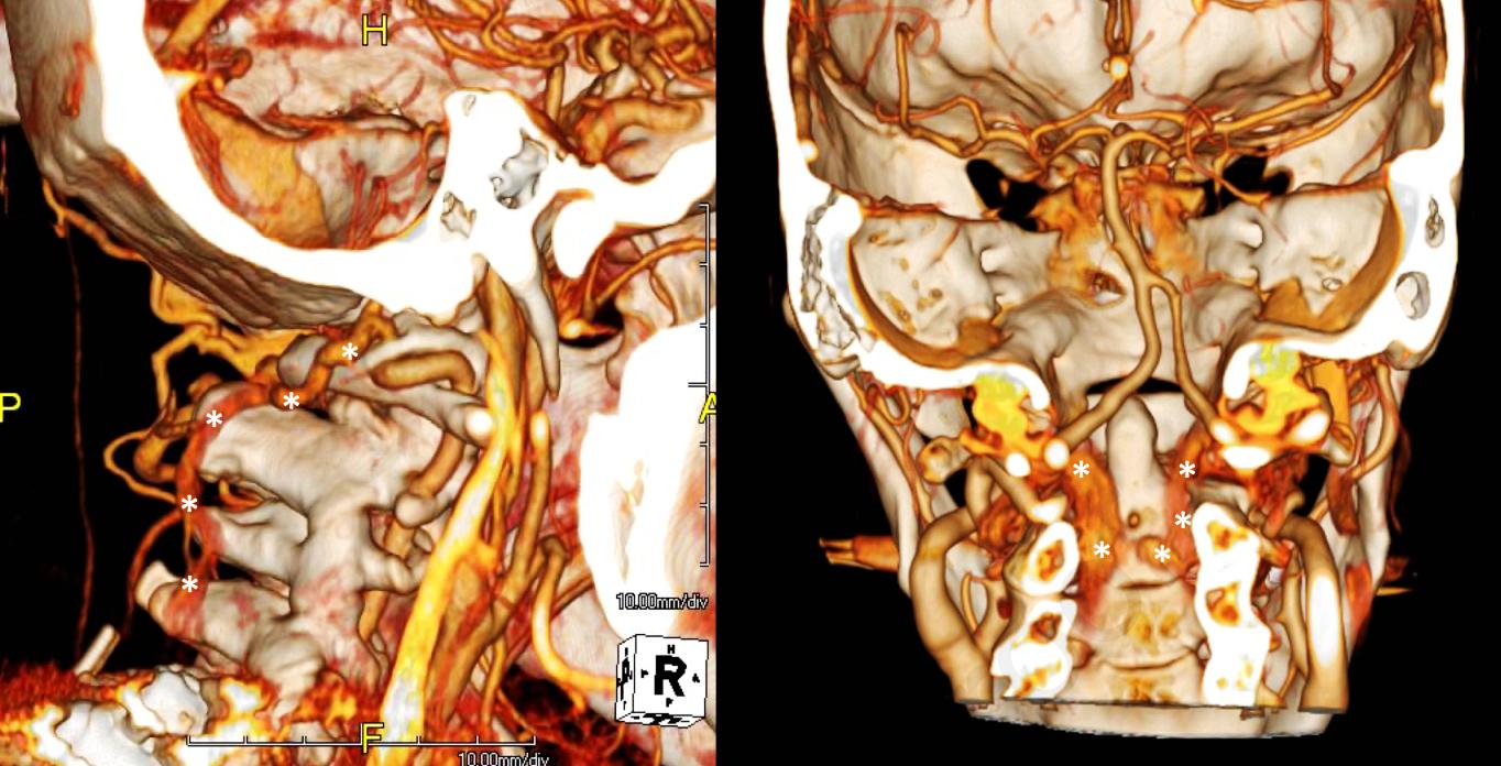文献查阅|文献综述——椎静脉丛
