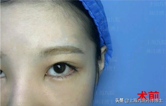 上海九院孙沣博士眼角修复,孙沣修复外眼角
