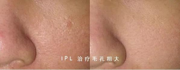 护肤光子嫩肤,光子嫩肤和脱毛操作