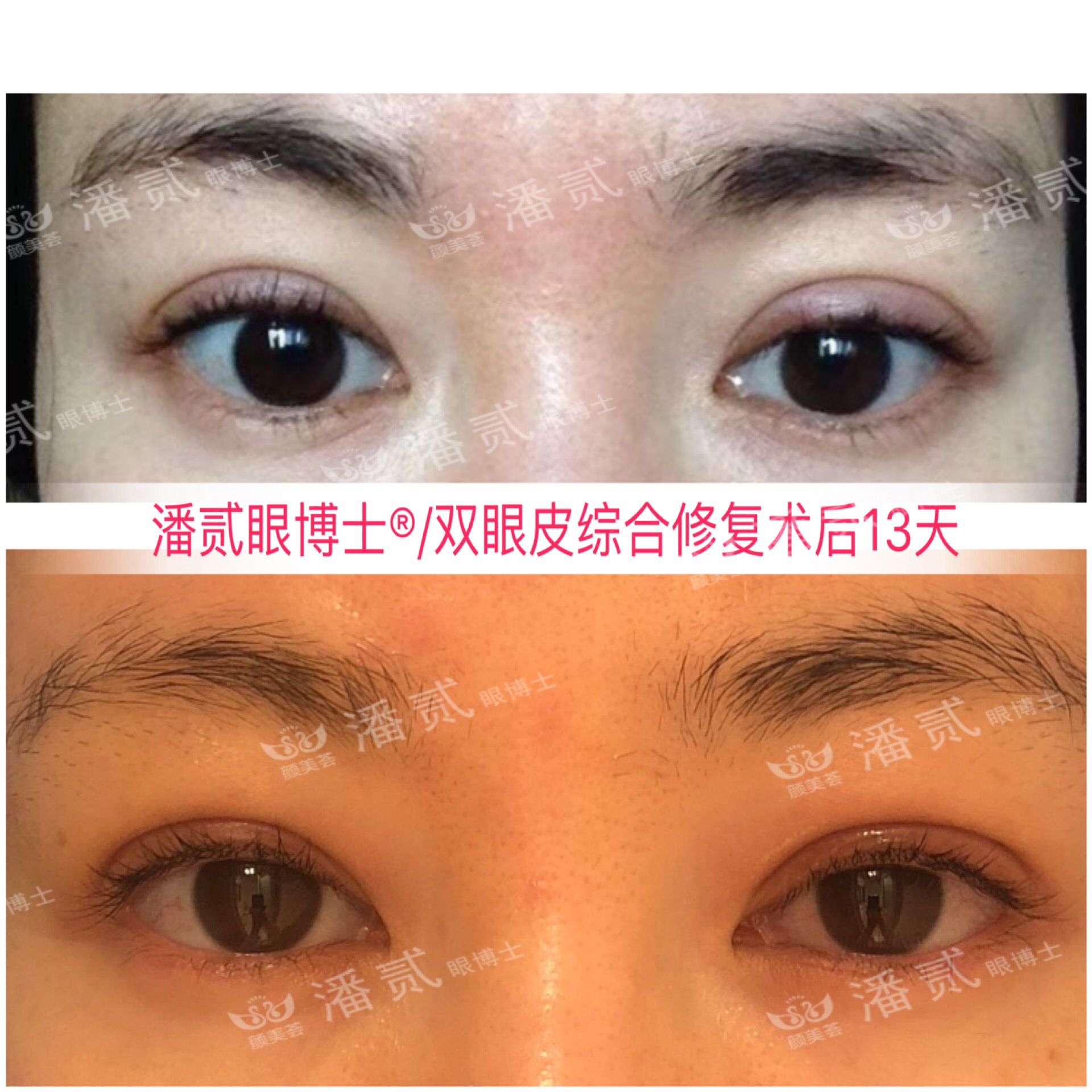 广州双眼皮修复内双,广州双眼皮修复可以只修眼尾吗