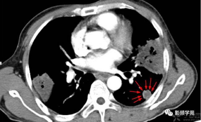 肺肉芽肿影像学表现ppt,肺韦格纳肉芽肿影像学表现