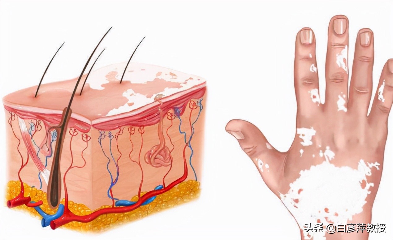 白癜风为什么难治,白癜风究竟能不能治好