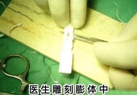 假体隆鼻能保持多久来了解一下,龚忠华整形