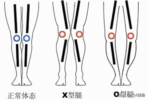 扁平足对运动有什么影响,扁平足适合什么运动项目