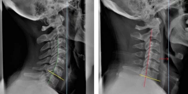 中年女士颈椎锻炼,颈椎病怎么健身