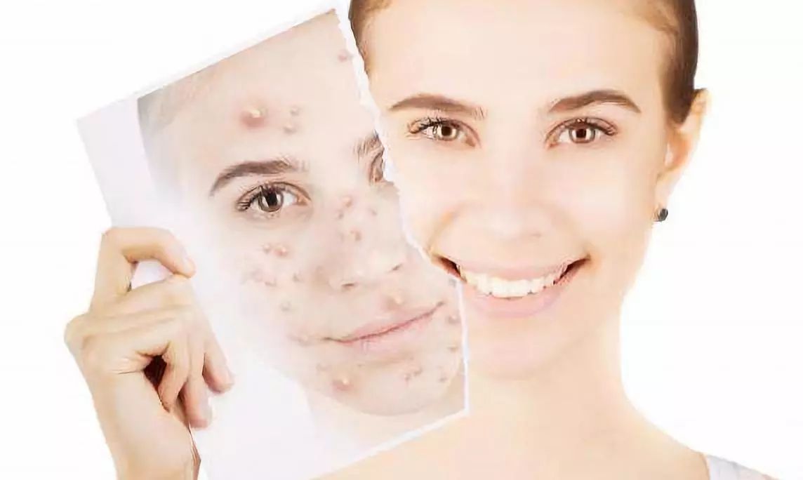 下巴和鼻子两侧老是反复长痘痘,鼻子里面长了一个痘痘怎么回事