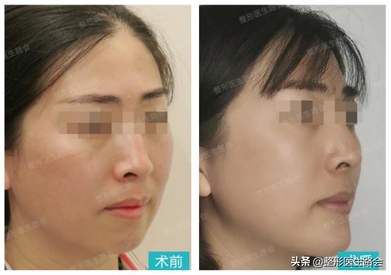 垫下巴手术流程,垫下巴手术的全过程