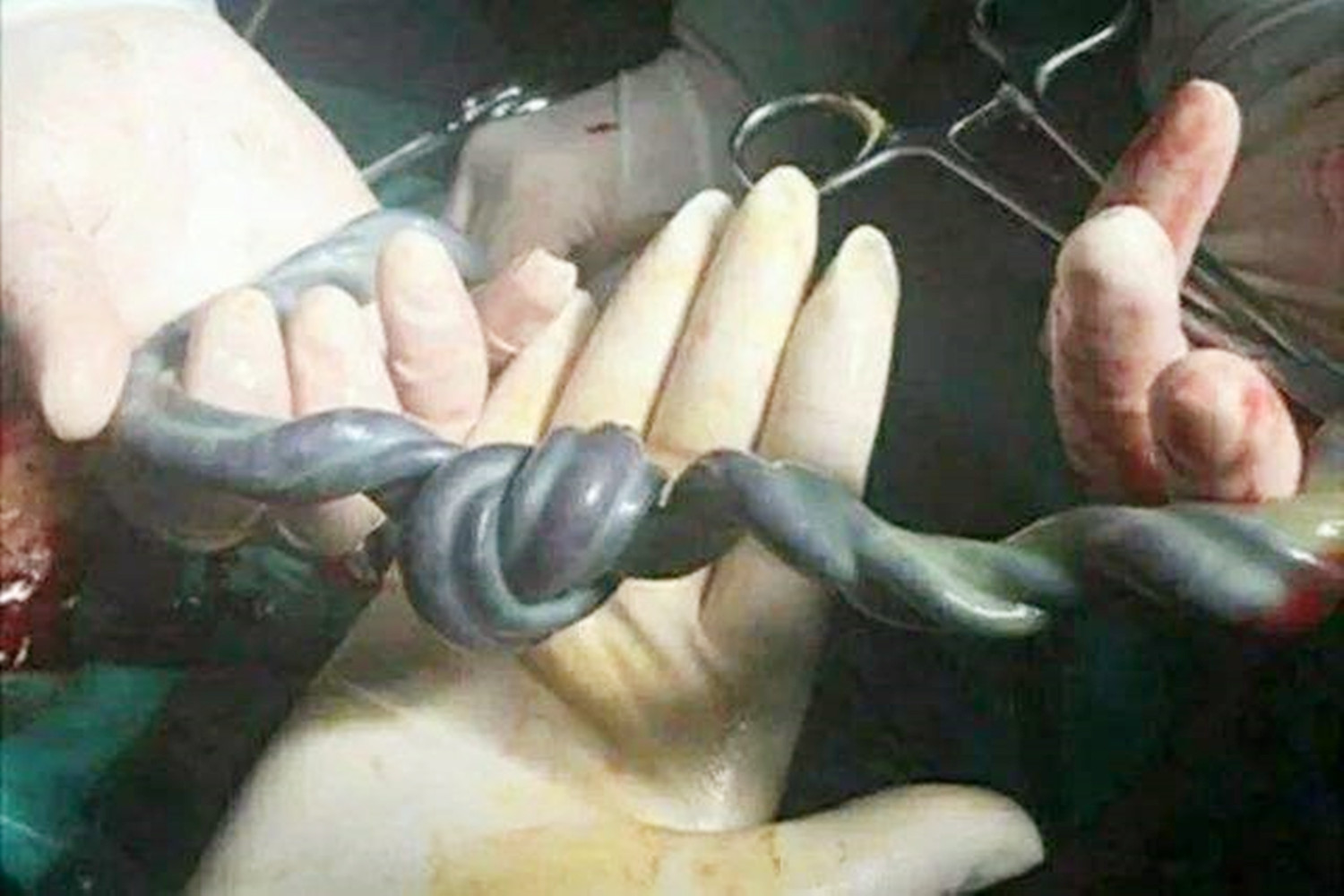 脐带断裂胎儿在子宫内能存活多久,孕晚期脐带断裂的原因