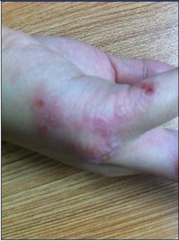 面部皮炎湿疹反反复复,反反复复起湿疹